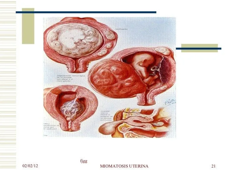 07-miomatosis-uterina-21-728. ...