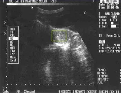 1º ecografia, 4 semanas de embarazo)