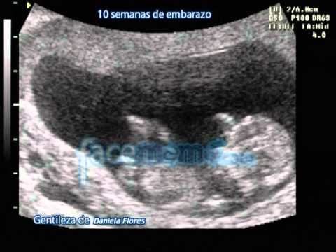 10 semanas de embarazo - YouTube