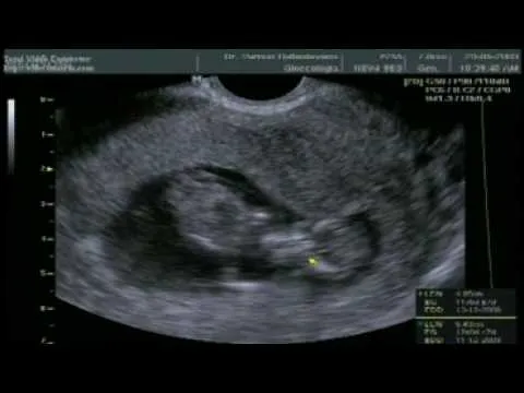 11 semanas de Embarazo y 4 dias - YouTube