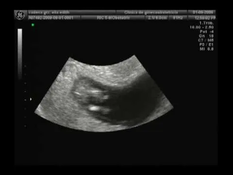 12 semanas de embarazo 1er ultrasonido - YouTube