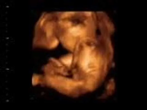  ... 3D tiempo real (4D) de un bebe a las 24 semanas de gestacion