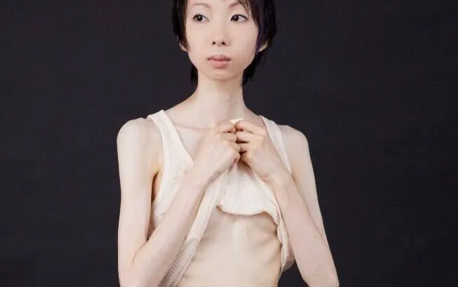 Anorexia é a doença mental que mais mata no mundo', diz ...
