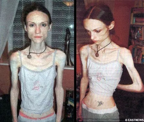 anorexia1mc3.jpg