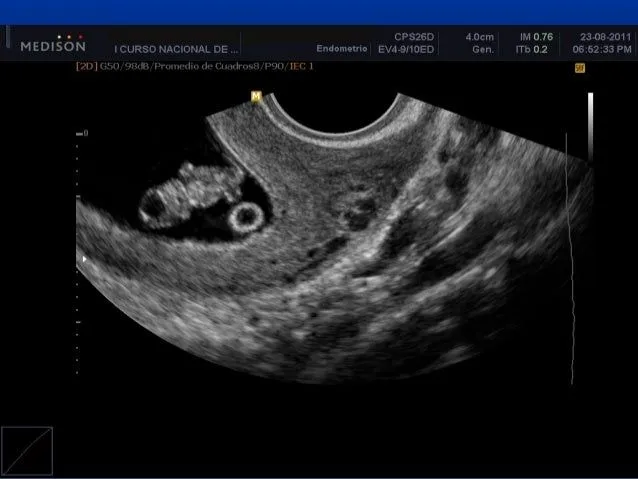 Avances en ecografia embrionaria agosto 2011