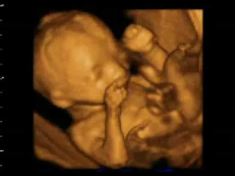 Bebé abre boquitaa en ecografía 4D del Instituto de Ginecología y ...