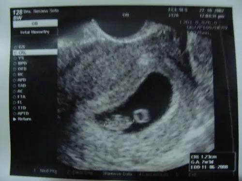 Nuestro bebe Precioso a las 7 semanas de Gestación Nuestro bebe Precioso a las 7 semanas de Gestación