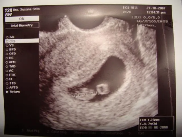 Nuestro bebe Precioso a las 7 semanas de Gestación | Flickr ...