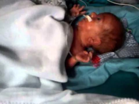 Bebe prematuro Pol,28 semanas de gestacion (cir4) 590gr. - YouTube