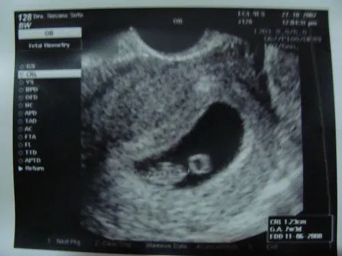 7 semanas de embarazo fotos del bebé - Imagui
