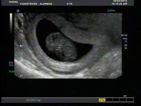Gestacion de 9 semanas de embarazo - Imagui