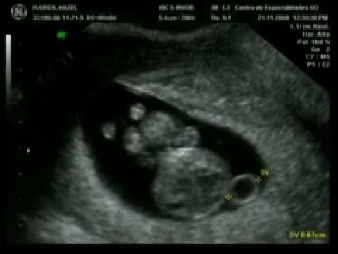 Ultrasonido de gemelos de 2 meses - Imagui