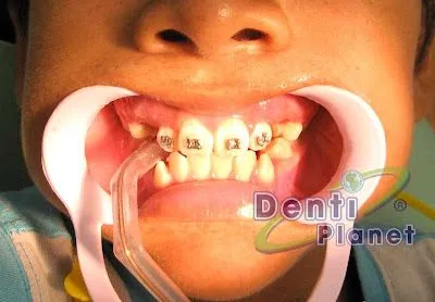 Blog Ortodoncia Dentiplanet: agosto 2009