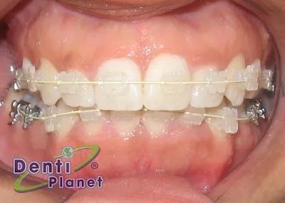 Blog Ortodoncia Dentiplanet: ¿Los brackets transparentes se manchan?