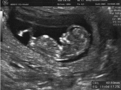 Semana 12 de embarazo ecografía - Imagui