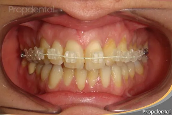 Brackets estéticos | Preguntas y caso clínico de ortodoncia Brackets estéticos | Preguntas y caso clínico de ortodoncia