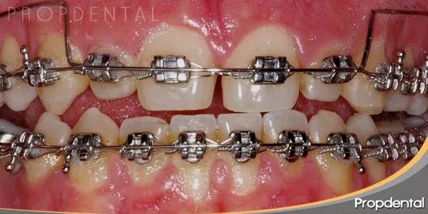 Brackets metálicos | Caso clínico y Preguntas aparatos de ortodoncia