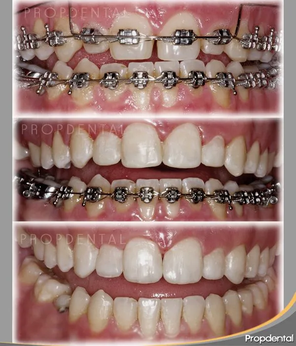 Brackets metálicos | Caso clínico y Preguntas aparatos de ortodoncia Brackets metálicos | Caso clínico y Preguntas aparatos de ortodoncia