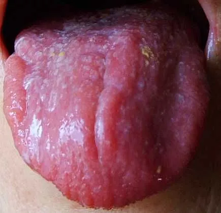 Cambios de color de la lengua asociada a enfermedades digestivas ...