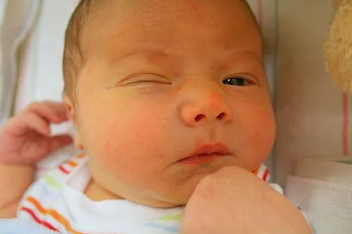 La conjuntivitis en el bebé recién nacido