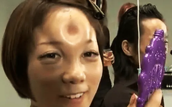 Deformación del rostro con bultos circulares, una moda en Japón (+ ...