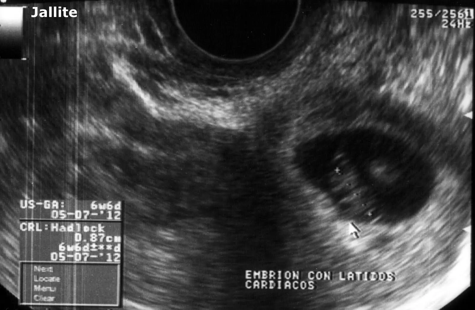 Diario de un Medico II: Embarazo Gemelar Embrion Vivo + Huevo Muerto