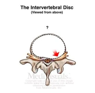 Disc Herniation and Other Disc Injuries