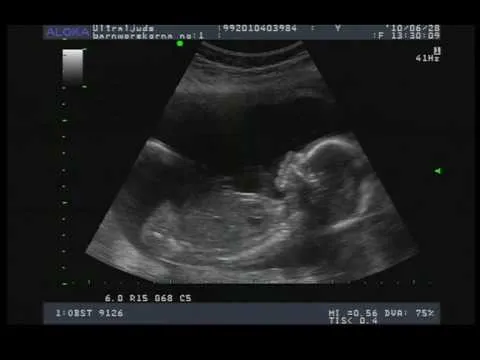 Eco 5 mes de embarazo - Imagui