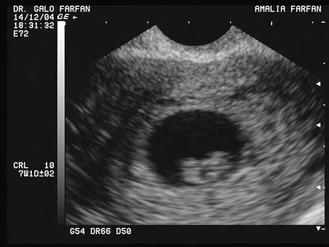 Ecografia 4 semanas de embarazo - Imagui