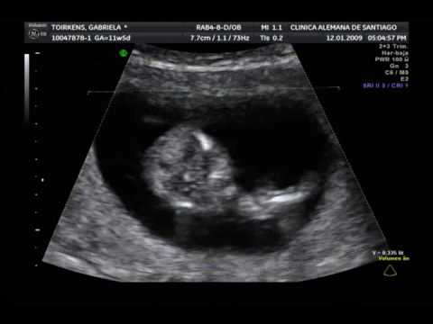 Ecografia 12 semanas Embarazo - YouTube