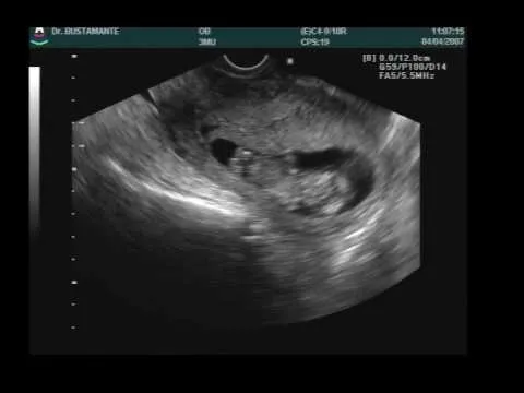 Ecografia 12 semanas embarazo - Imagui