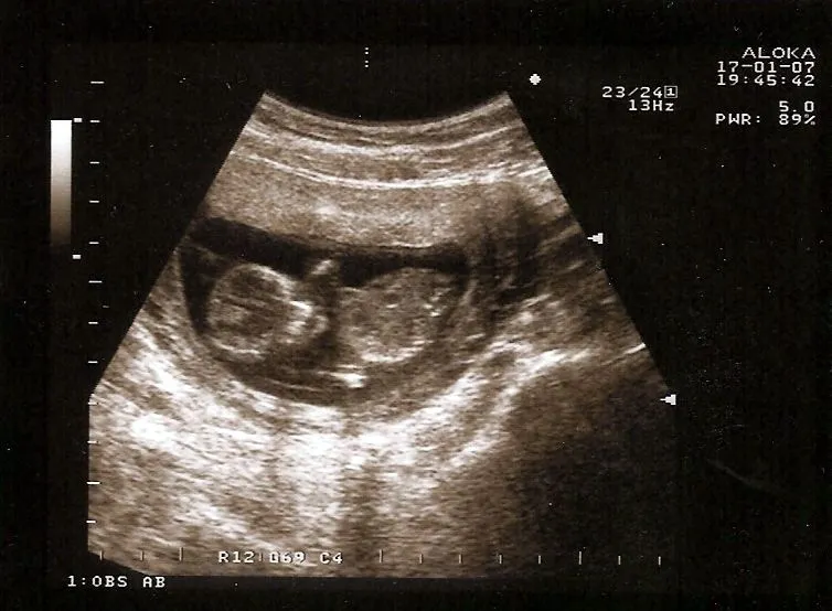 13 semanas de embarazo fotos de ecografias - Imagui
