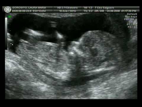 15 semanas de embarazo ecografia - Imagui