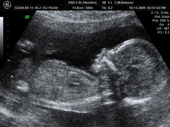 Embarazo de 16 semanas ecografia - Imagui