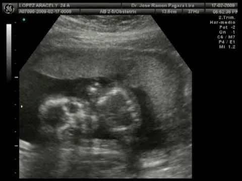 Ecografia 19 semanas de embarazo - Imagui