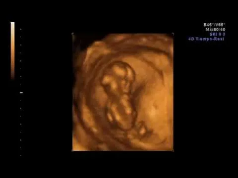 Ecografía 4D, feto de 8 semanas y 6 días - YouTube