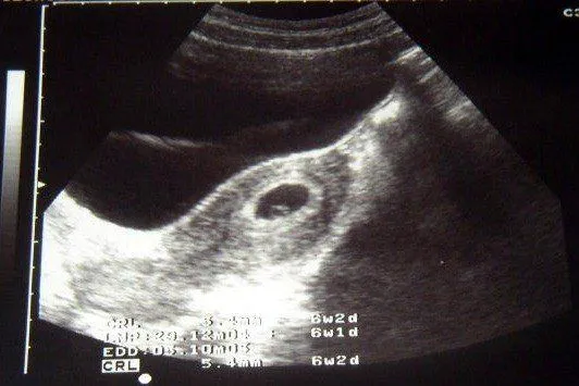 Ecografías de embarazo de 6 semanas de gestación - Imagui