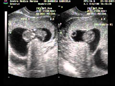 Ecografía 9.2 semanas de embarazo gemelar bicorial - YouTube