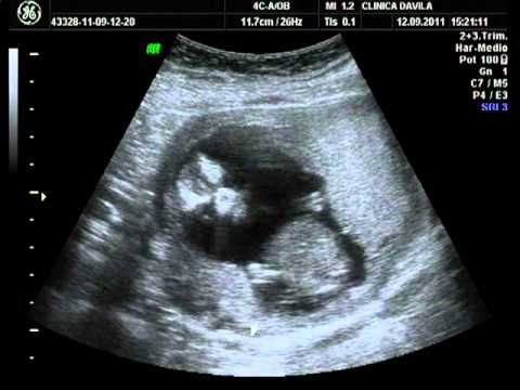 Ecografía de mi Bebé a las 15 semanas de gestación - YouTube