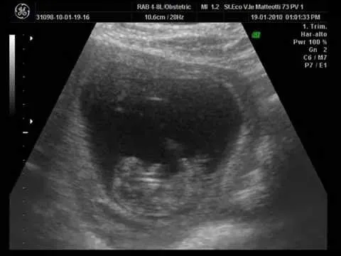 ecografia de mi bebe..."mi primogenito" 2 meses y 1/2 - YouTube