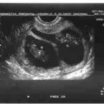 La ecografía en embarazo de gemelos | El Embarazo: todo lo que una ...