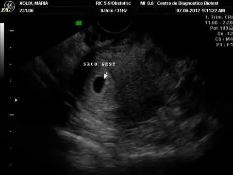 ecografia de un embarazo de 1 mes - YouTube