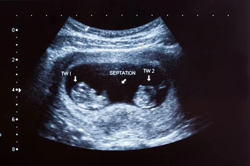 La ecografía en el embarazo múltiple - EMBARAZOYMAS