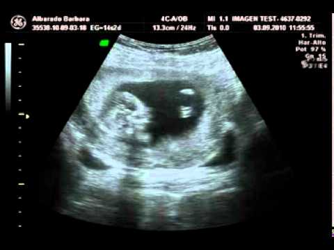 Ecografia embarazo semana 14 - YouTube