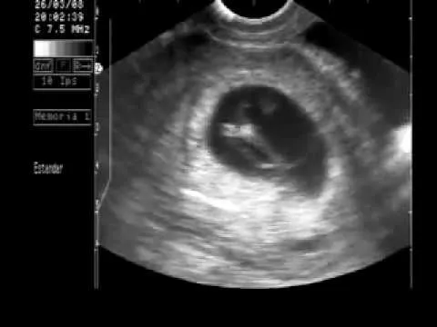 2 semanas de embarazo ecografia - Imagui