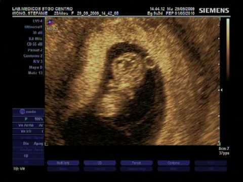 Ecografia embarazo 9 semanas y 3 dias - YouTube