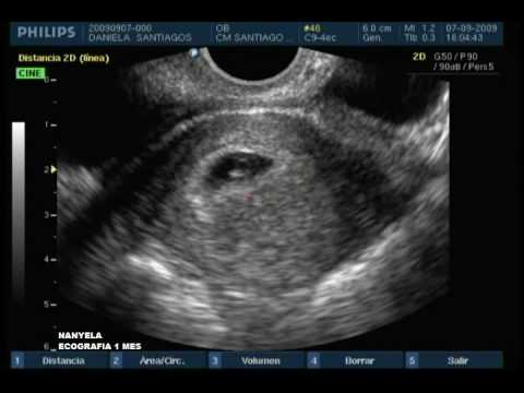 Ecografias primer mes de embarazo - Imagui