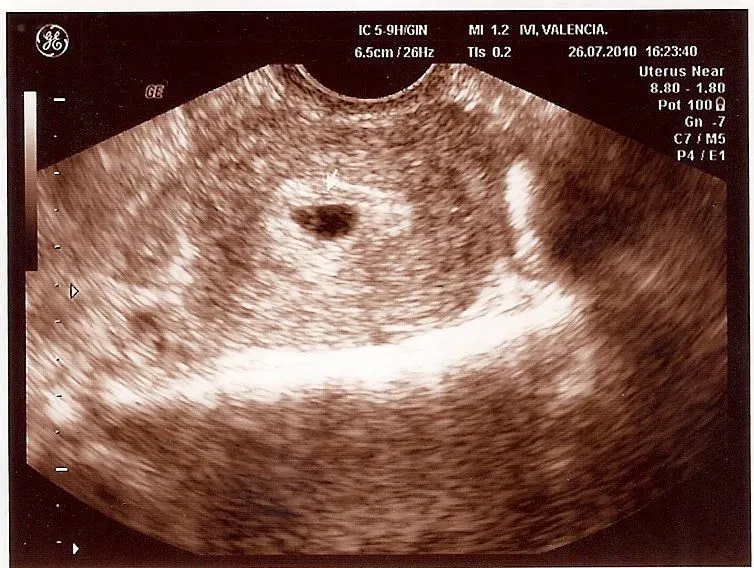 Ecografía de 5 semanas de embarazo - Imagui
