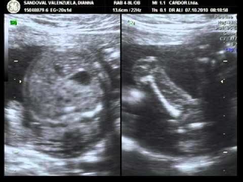 Mi ecografia de 5 meses de embarazo - YouTube