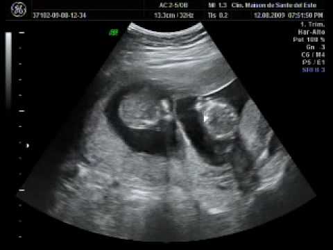 Ultrasonido gemelos 4 meses - Imagui
